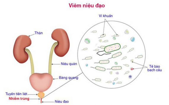 Phòng ngừa viêm niệu đạo