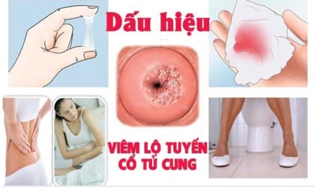 dấu hiệu viêm lộ tuyến cổ tử cung dễ nhận biết - GOTOWOMEN TW3