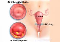[ GIẢI ĐÁP ] Viêm cổ tử cung là bệnh gì ? 5 nguyên nhân gây ra